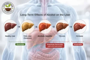 Stages of alcoholic liver disease from fatty liver to cirrhosis
